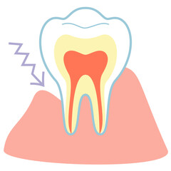 歯茎が落ちて痛みが滲みる歯の断面図