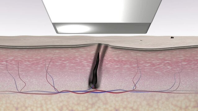 Laser hair removal. Destruction of hair follicles after laser beams action. 3d animation for advertising medical laser devices
