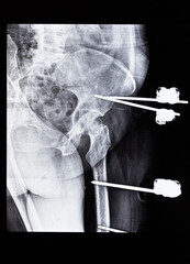 x-ray with external fixation device fixed in femur and pelvic bones