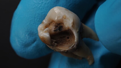 Tooth decay and dentist hand with glove and black background. Macro shot of a decayed teeth till root after extraction of dentist. Real tooth anatomy due lack of dental care. Top view of caries teeth