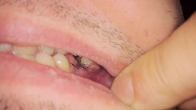 Male patient opens mouth to show seam with black threads put on gum. Implant placement after tooth removal in dental clinic extreme closeup