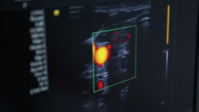 Ultrasound of the thyroid gland, close-up of the monitor, examination, the doctor conducts an examination of the patient, modern medicine.