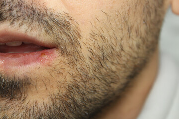 Herpes labials infection on the lips of a man. Close up.
