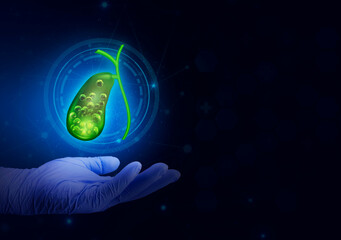 Gallbladder with stone. Care and treatment of gallstones, cholecystitis, surgical removal. modern...