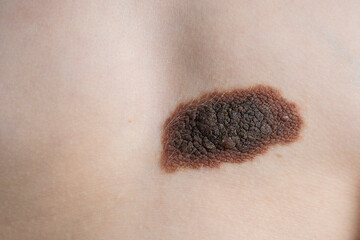 A large birthmark on the skin of a young girl's breast. The concept of imperfections and skin problems.