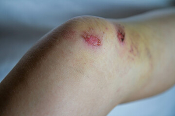 Fototapeta premium Wounded knee with oozing cuts and bruise