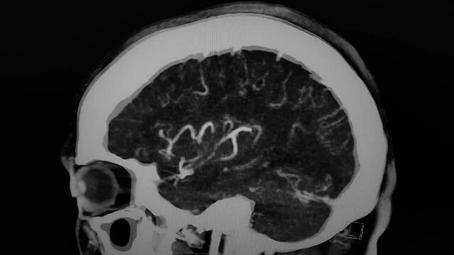 CT Brain angiography - sagittal image in black, white