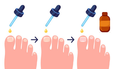 Nail plate treatment cartoon vector illustration. Steps of the treatment of the nail plate with the solution.