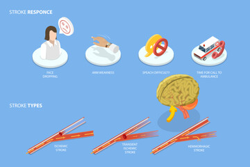 3D Isometric Flat Vector Conceptual Illustration of Brain Blood Supply Problem, Ischemic Stroke Attack