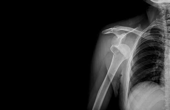 Photo of plain radiograph on dark background in hospital. The film use for diagnosis the illness of patient.Medical concept. Fracture proximal humerus arm in osteopenia patient. Elderly broken bone.