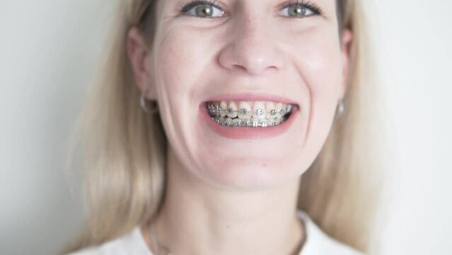 A close-up of the face of a girl in braces smiles broadly