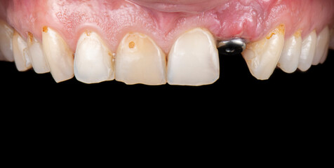 emax ceramic crowns and veneers