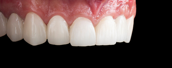 emax ceramic crowns and veneers