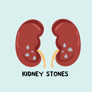 stones kidney vector , kidney disease illustration vector clipart