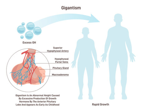 Gigantism. Syndrome characterized by excessive secretion of growth