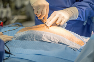 A chief physician in heart surgery opens the thorax with a scalpel in order to be able to place a...