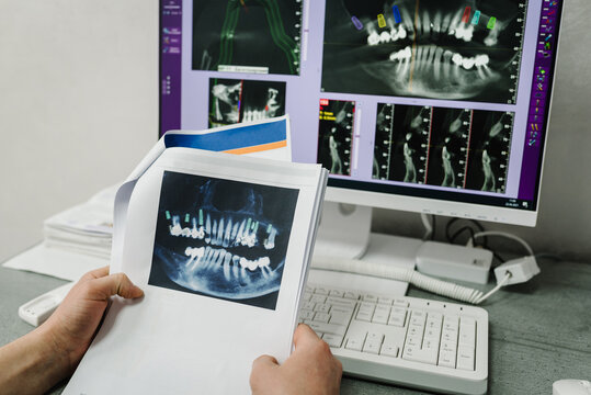 X-ray image on display on a computer screen to patients. Doctor presenting photo with tooth x-ray film recommend patient in treatment of dental and dentistry. Preparation for prosthetic teeth. Closeup