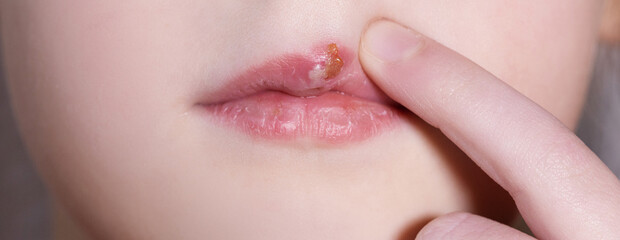 Children's herpes virus on the lip of a sick girl. The child points a finger at the wound on the upper lip. Close-up of the disease