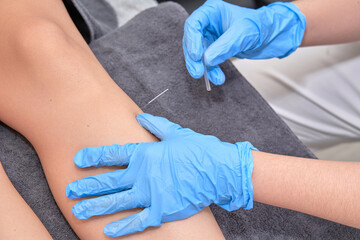  Close-up of physiotherapist performing dry needling treatment on leg. Injury recovery procedure 
