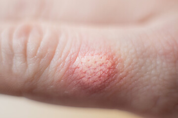 Burned skin on a finger of Caucasians man hand - closeup