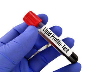 Blood sample for Lipid profile, Triglyceride, HDL and LDL test. Copy space on white background - obrazy, fototapety, plakaty
