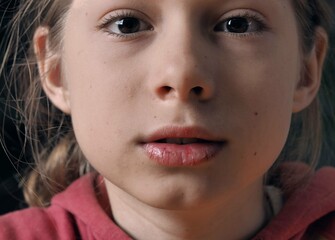 The face of a teenager with chapped lips and symptoms of diathesis.Close up.The concept of medicine, dry skin and treatment of diathesis in children.