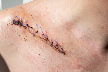 Suture wound after fracture of the right clavicle after surgery - obrazy, fototapety, plakaty