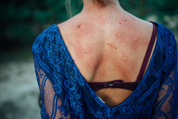 mosquito bites the back of a girl