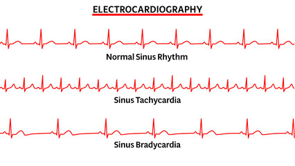 Set of ECG Common Abnormalities - Normal Sinus Rhythm - Sinus Tachycardia - Sinus Bradycardia - Vector Medical Illustration