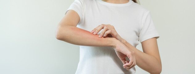 Dermatology asian young woman, girl allergy, allergic reaction from atopic, insect bites on her...