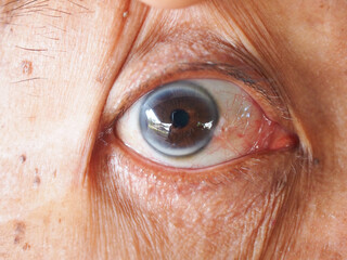 Close up eye arcus senilis disease in elderly man.