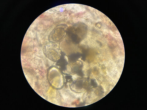 Scabies, Notoedres egg under the Microscope.