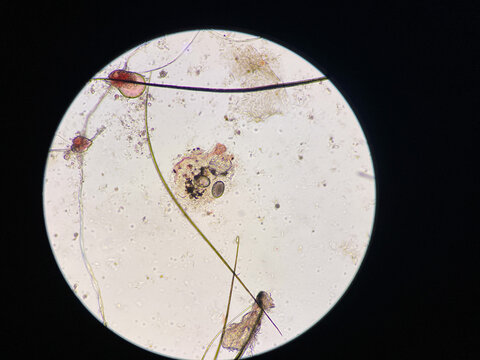 Scabies, Notoedres egg under the Microscope.