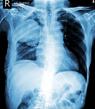 pneumothorax on ICD. chest x ray AP supine 