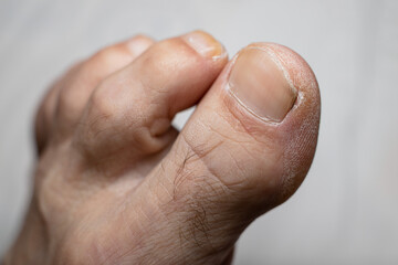 Older man feet fingers - dry skin - Shallow focus blur background