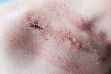 Suture wound after fracture of the right clavicle after surgery