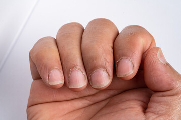 Close up of fingers with dry, cracked skin on cuticles, skin is torn and flaking off