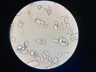 Microscopic view of struvite crystals from urinary sediment. Magnesium ammonium phospate crystals. Causing Feline Lower Urinary Tract Disease