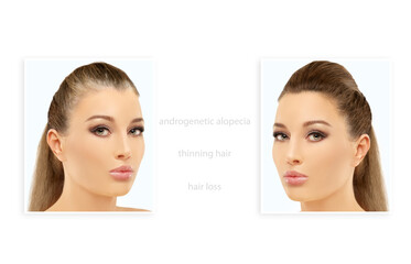 Alopecia Areata,female pattern baldness,Treatment for hair loss,Hair transplant,Surgery to implant...