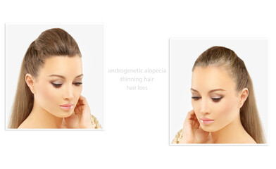 Alopecia Areata,female pattern baldness,Treatment for hair loss,Hair transplant,Surgery to implant...