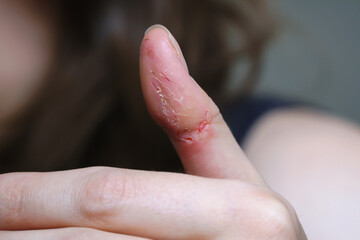 Realistic image of skin damage from dermatillomania