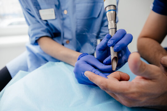 Removal of benign tumors in a beauty salon. The use of laser in dermatology. Photo of a laser beam on a patient's arm