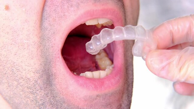 closeup male doctor conducts an examination of oral cavity of young male patient, tries on Silicone Night Mouth Guard for Teeth Clenching Grinding Dental Bite Sleep Aid, concept of dental services