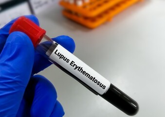 Obraz premium Blood sample for Lupus Erythematosus or LE test, an autoimmune disease in which the immune system attacks its own tissues causing widespread inflammation and tissue damage.