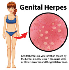 Genital Herpes infographic with explanation