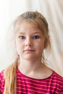 portrait of a cute blonde girl suffering from chicken pox
