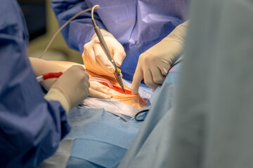 A chief physician in cardiac surgery opens the chest with an electronic scalpel in order to be able...