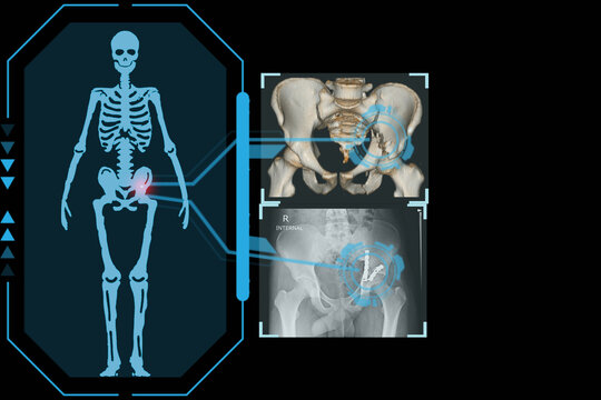 Examines a technological digital holographic plate representing the patient's body, Transverse fracture of acetabulum pelvis, Concept: Futuristic medicine, Medical technology concept.