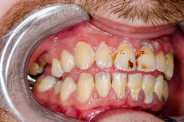 frontal, intraoral, mundhygiene