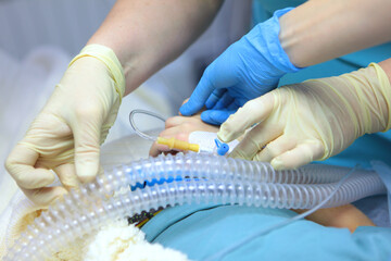 Preparing the child for anesthesia. Dental surgery under general anesthesia. Surgical intervention....